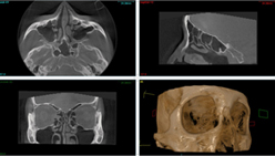 低被ばく・高解像度・3D-CT